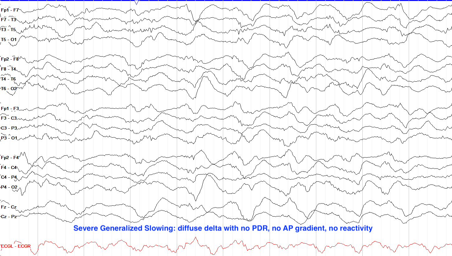 Slowing And Other Non Epileptiform Abnormalities